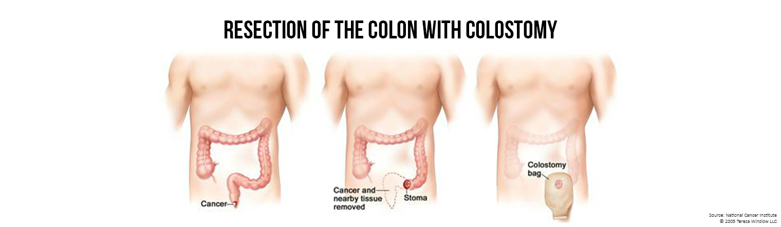 Banner Resection and Colostomy