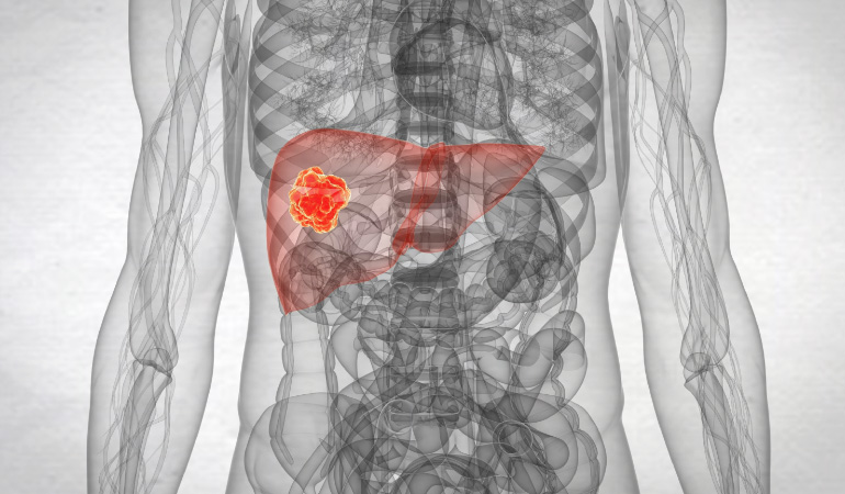 What treatments are available if you have an adenocarcinoma of the liver?