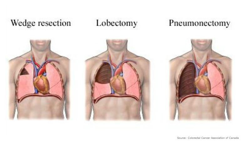 Lung Metastases - Diagnosis, Prognosis & Treatment