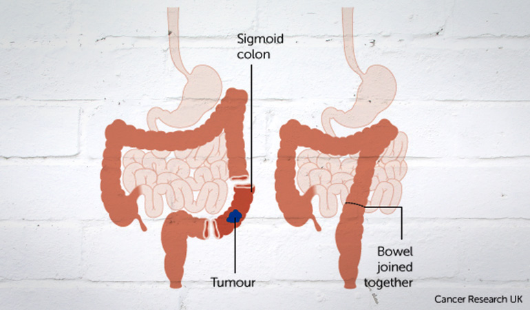 About_Bowel_Cancer_Sigmoid_Tumor