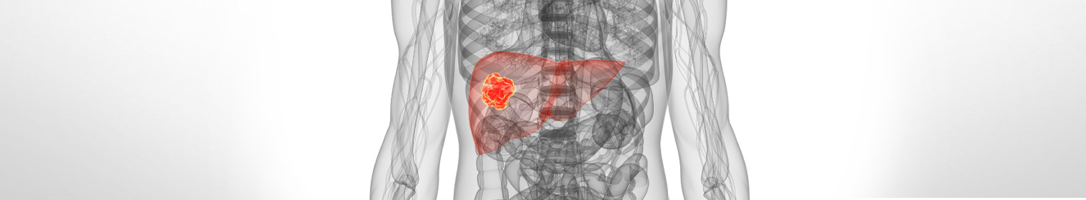 Metastatic bowel cancer Liver