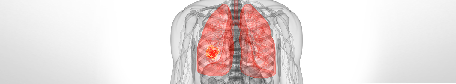 Metastatic bowel cancer Lung