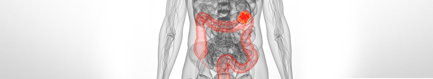 Metastatic bowel cancer Peritoneal