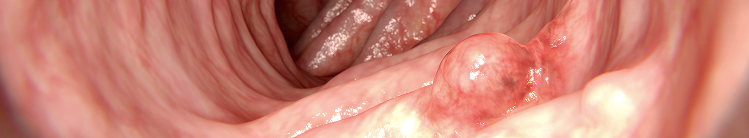 Polyp Removal