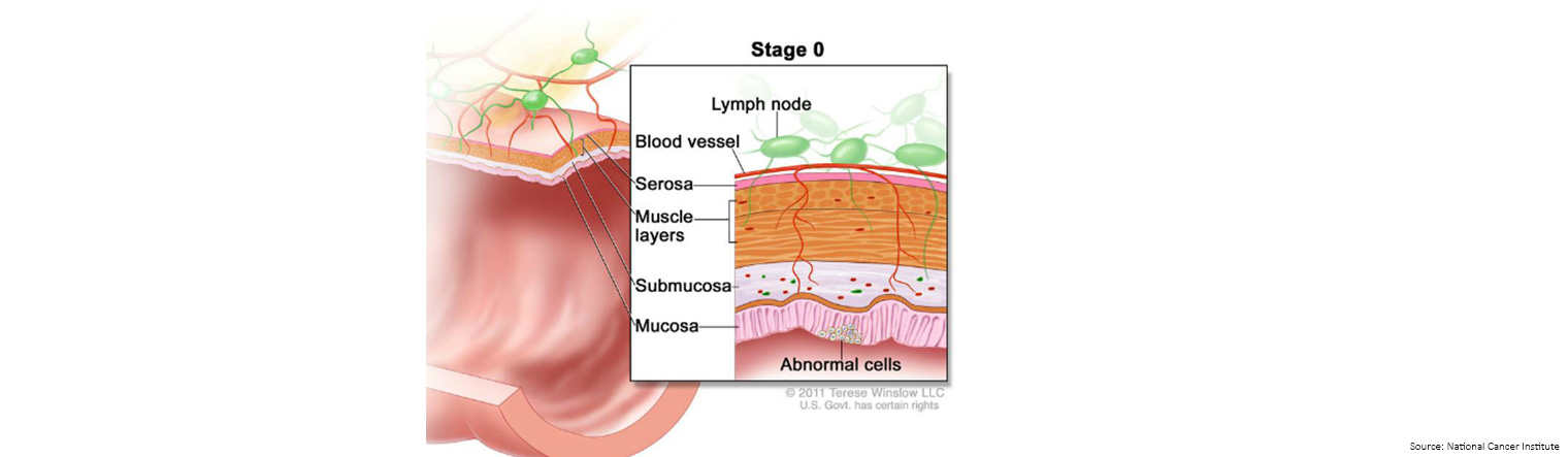 Bowel Cancer Staging Stage 0