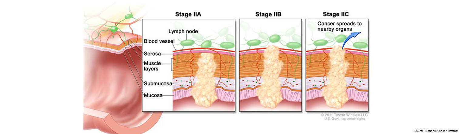 Bowel Cancer Staging Stage 2