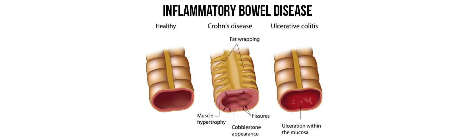  Inflammatory Bowel Disease