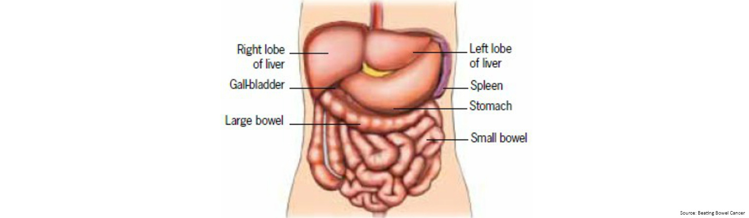 Metastatic bowel cancer