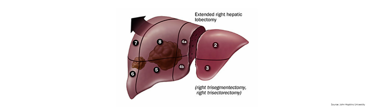 Metastatic bowel cancer 