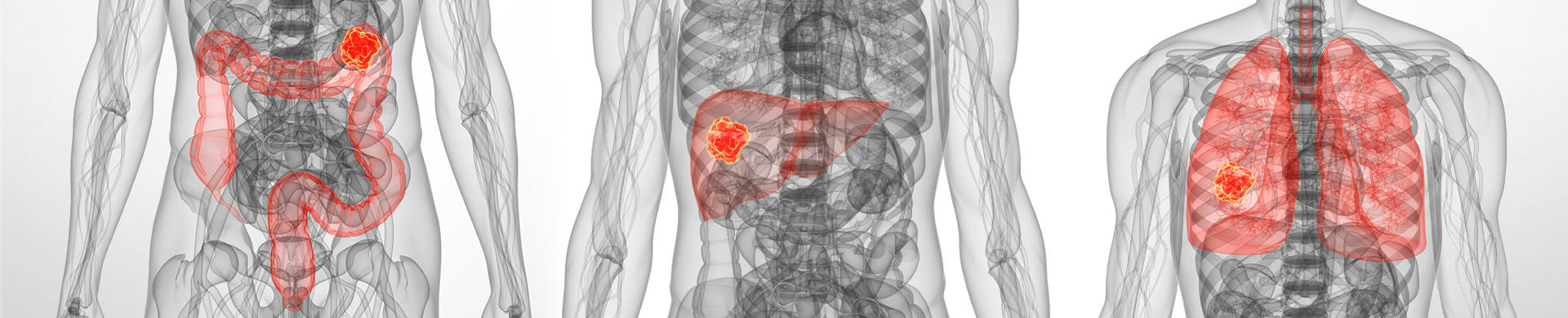 Neuroendocrine cancer spread to liver and bones