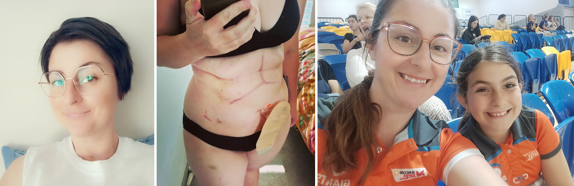 A collage featuring three images: a woman smiling, a close-up of a surgical scar, and two women posing together.