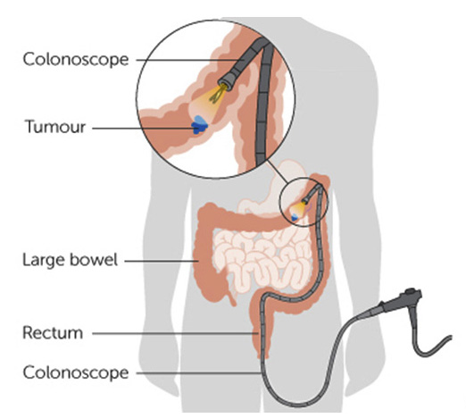Understanding A Colonoscopy Procedure Understanding A Colonoscopy Procedure