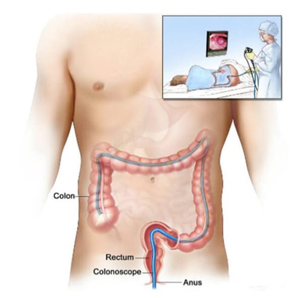 Tests & investigations - Bowel Cancer Australia