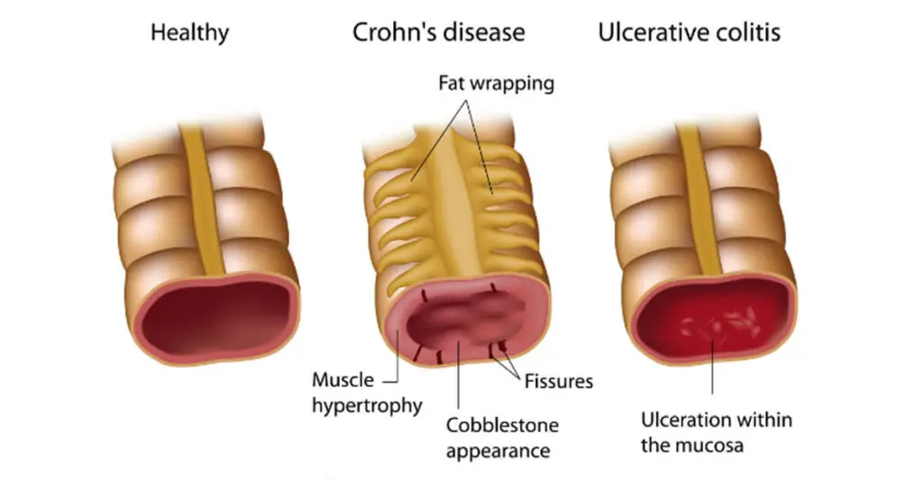 semaglutide and inflammatory bowel disease Does reduce diarrhea in Crohn's patients? GLP-1RAs for IBD | Docwire
