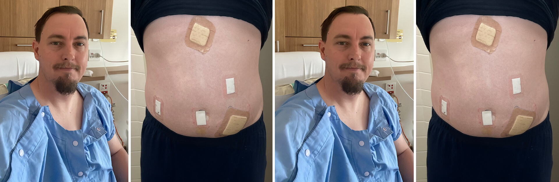 A man in a hospital gown poses, showing his abdomen with several bandages on it.