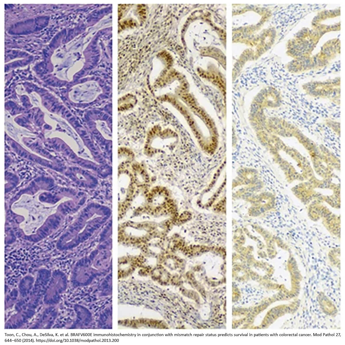 Three microscopic images showing tissue sections with varying staining patterns related to colorectal cancer analysis.