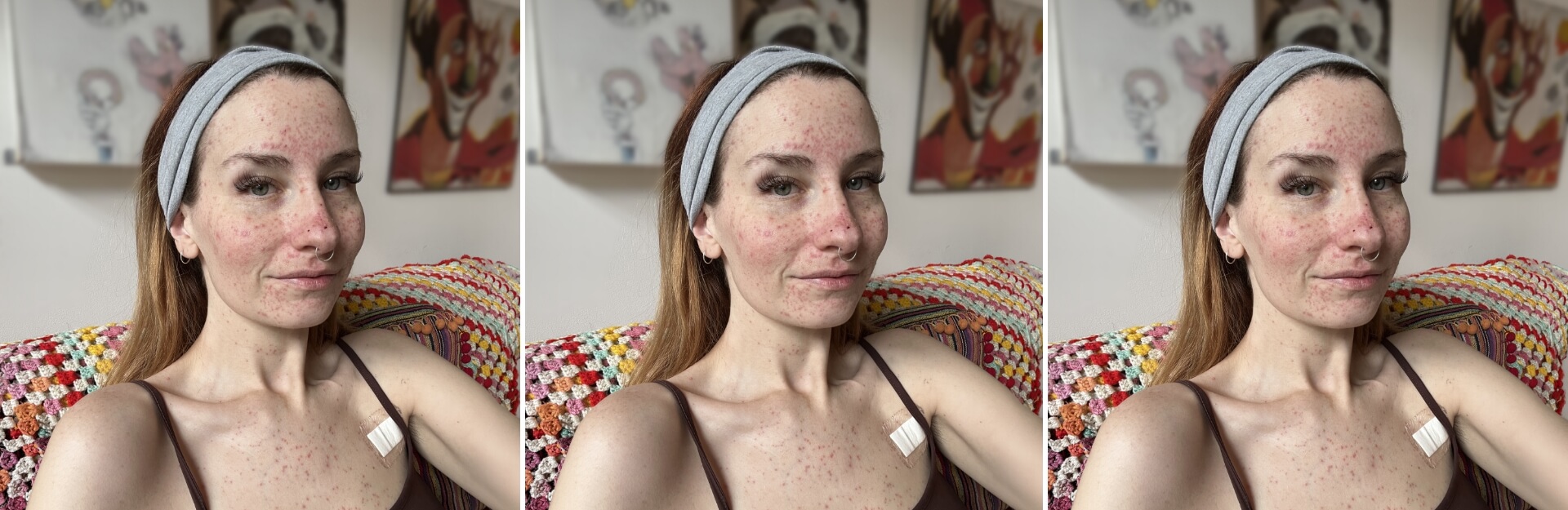 A woman with freckles and a headband sits on a colorful crocheted blanket, showing a bandage on her shoulder.